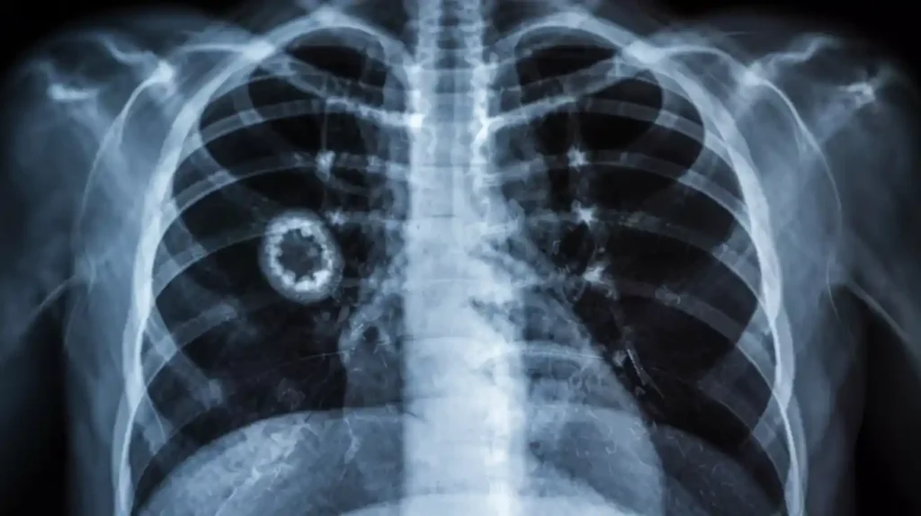Small cell lung cancer on the right side of chest in xray