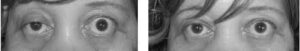 ptosis in myasthenia gravis