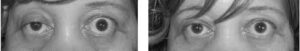 ptosis in myasthenia gravis