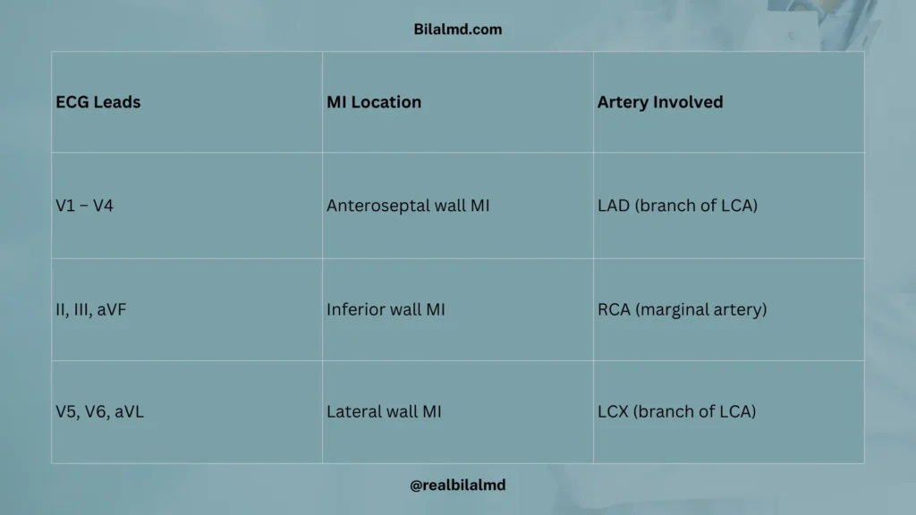 Table showing ECG leads with corresponding myocardial infarction location and involved artery: V1–V4 anteroseptal MI (LAD), II III aVF inferior MI (RCA), V5 V6 aVL lateral MI (LCX).
