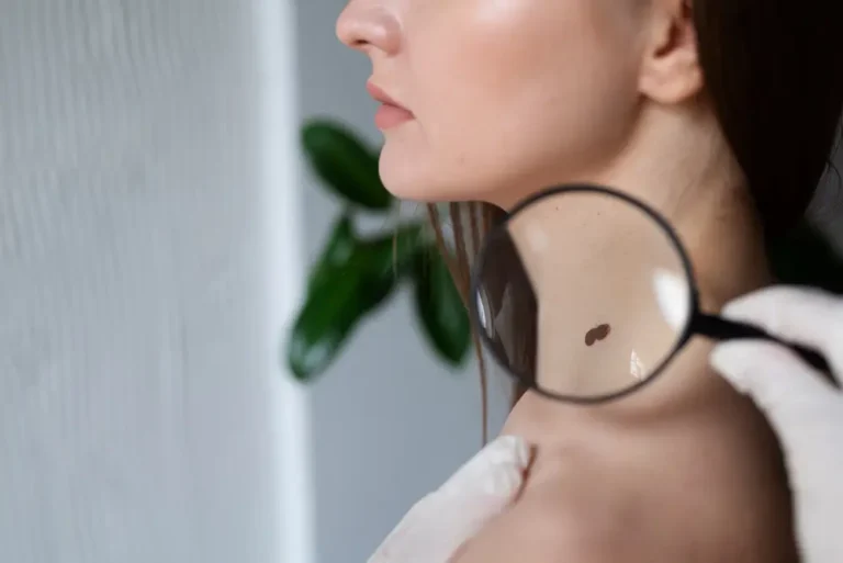 Dermatologist examining a brown mole or wart on a woman’s neck with a magnifying glass — concept of warts and skin tags diagnosis, skin check, and early detection of abnormal growths
