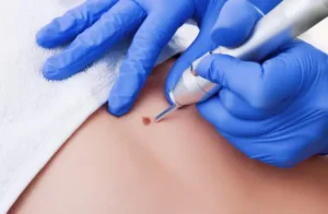 Dermatologist performing cryotherapy to remove warts using liquid nitrogen in a cosmetic clinic — close-up of skin treatment for safe wart removal.