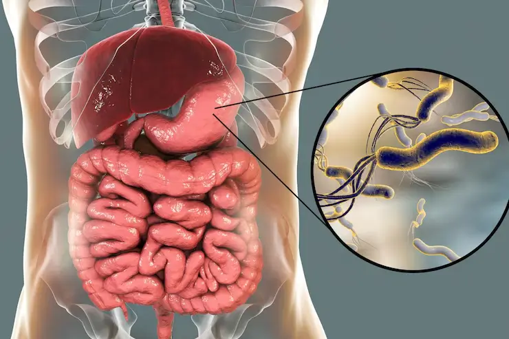 Illustration of H. pylori bacteria inside the stomach, showing how the infection affects the stomach lining.