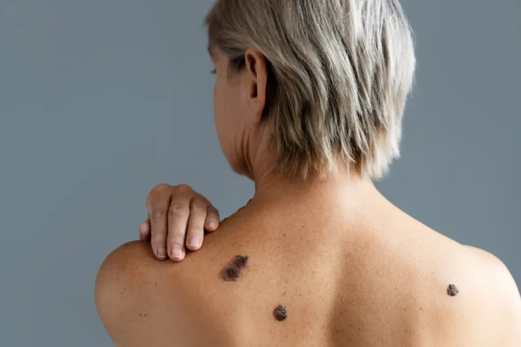 A middle-aged woman showing multiple skin tags on her back — representing common skin tag locations and appearances.