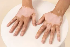 Hands showing vitiligo with well-defined depigmented patches on the backs of the hands and fingers