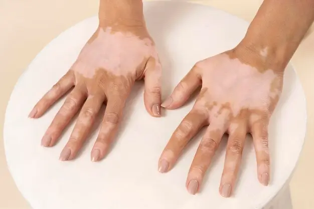 Hands showing vitiligo with well-defined depigmented patches on the backs of the hands and fingers