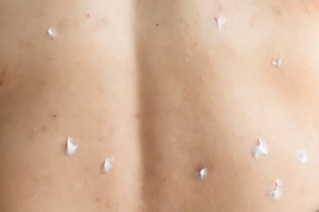 Close-up of a person's back showing white spots and uneven pigmentation after tanning, representing common post-tanning skin discoloration