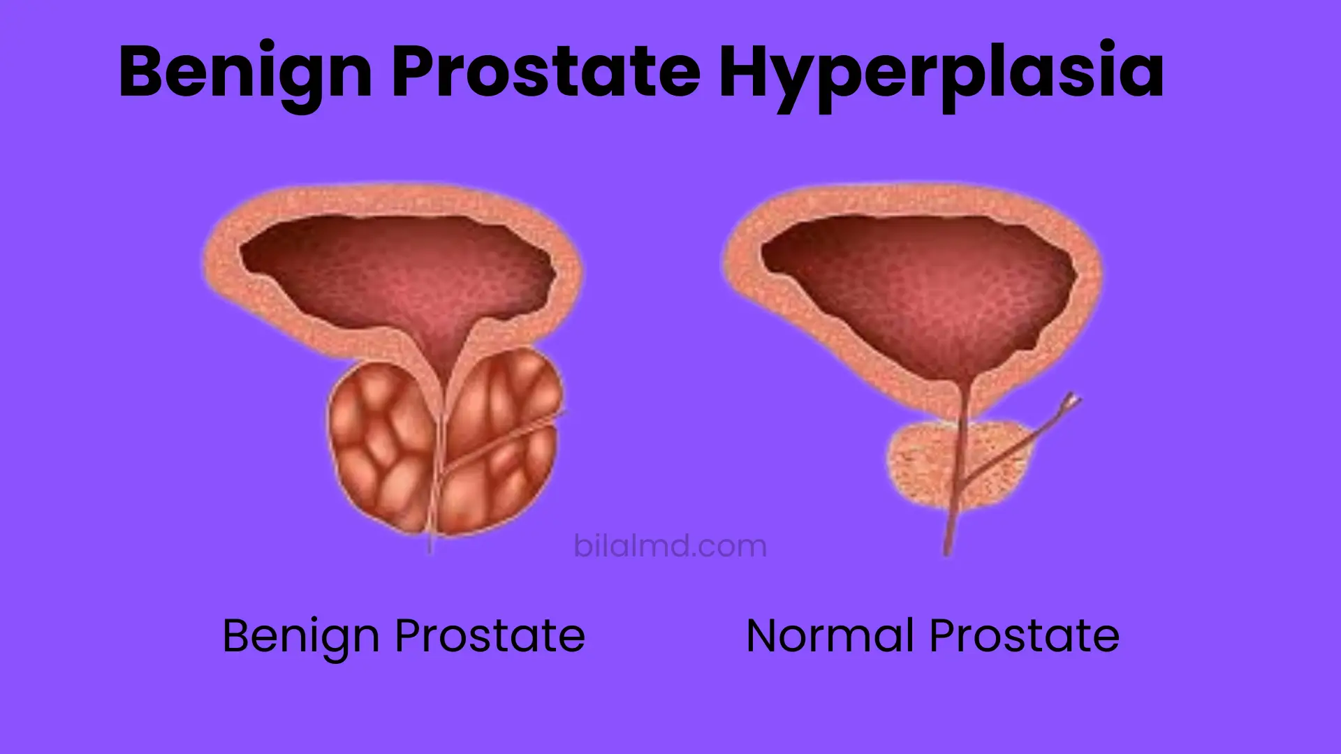 Benign Prostate Hyperplasia diagram comparing enlarged benign prostate with normal prostate anatomy.